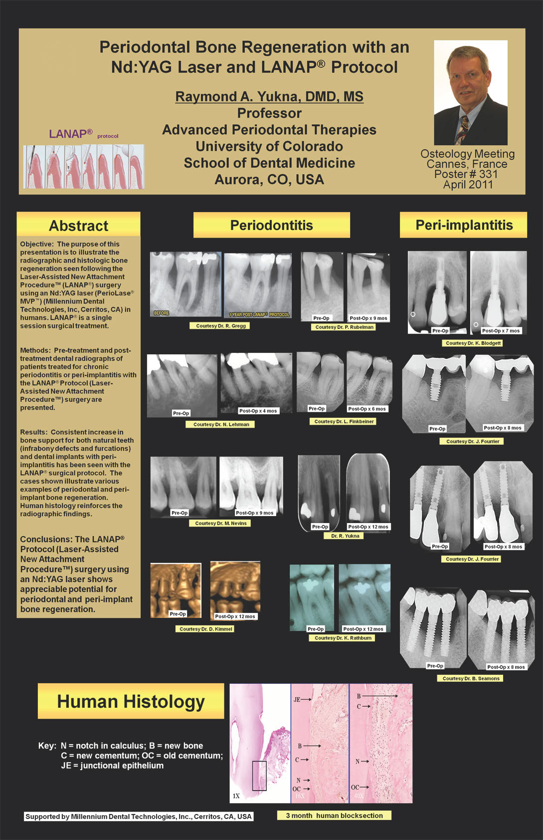 Laser Periodontal Therapy With the LANAP® Protocol Gets International Recognition