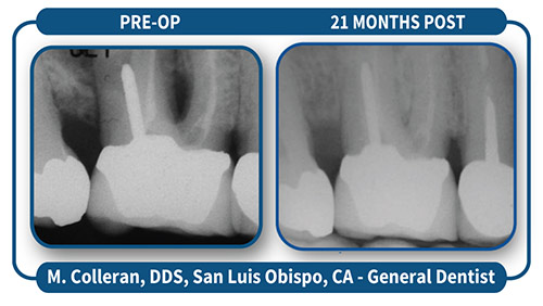 case-studies-LANAP-new4