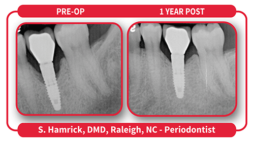 LANAP® and LAPIP™: Minimally Invasive Periodontal and Peri-implantitis  Treatment Protocols - Volume 38, Issue 8 - Compendium