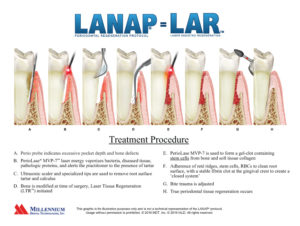 LANAP_steps_for_True_Regeneration