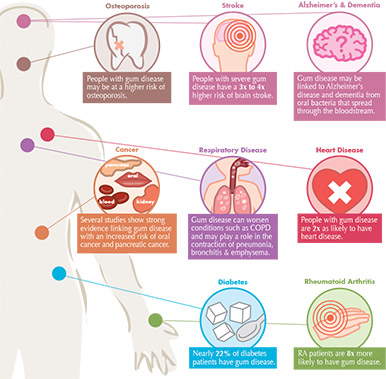 Gum Disease - Millennium Dental Technologies, Inc.