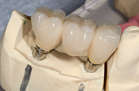 dental-implants