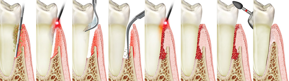 peridonitis