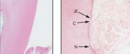 Histologic Evaluation of an Nd:YAG Laser Assisted New Attachment Procedure in Humans