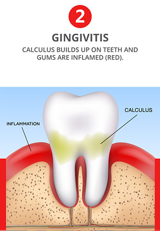 Gingivitis - Calculus builds up on teeth and gums are inflamed (red). Early stage of gum disease.