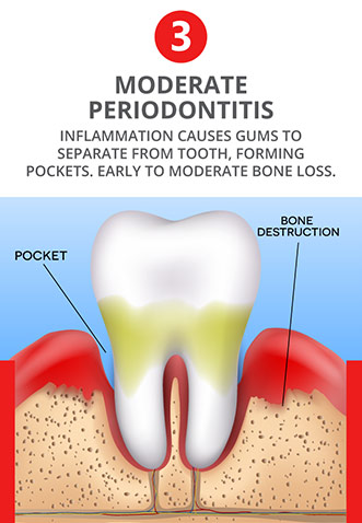 Moderate Periodontitis - Inflammation causes gums to separate from tooth, forming pockets. Early to moderate bone loss. Moderate gum disease.