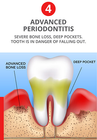 Advanced Periodontitis - Severe bone loss, deep pockets. Tooth is in danger of falling out. Advanced gum disease.