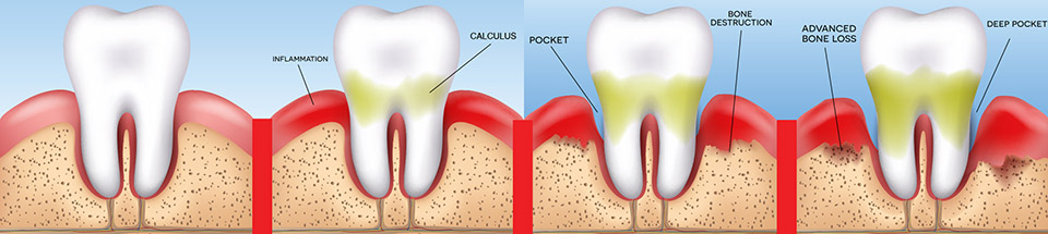 treatment-stages