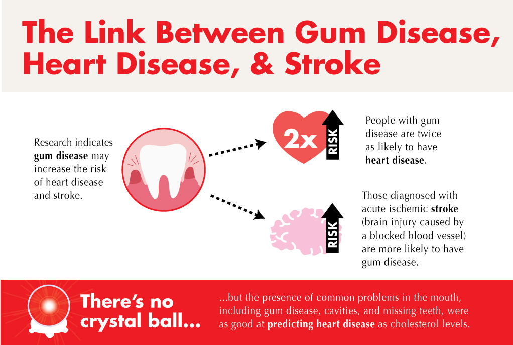 Uncovering the Connection between Stroke and Gum Disease