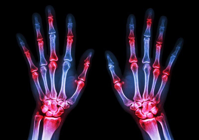 Periodontitis & Rheumatoid Arthritis:  Which Came First?