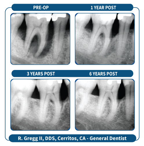 Lasers for Periodontal Bone Regeneration