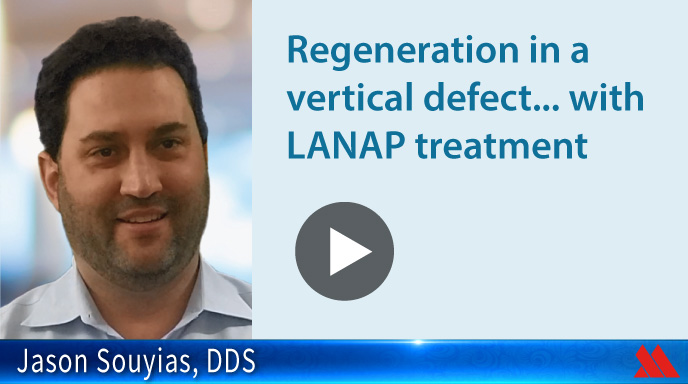 Regeneration in a vertical defect...with LANAP treatment