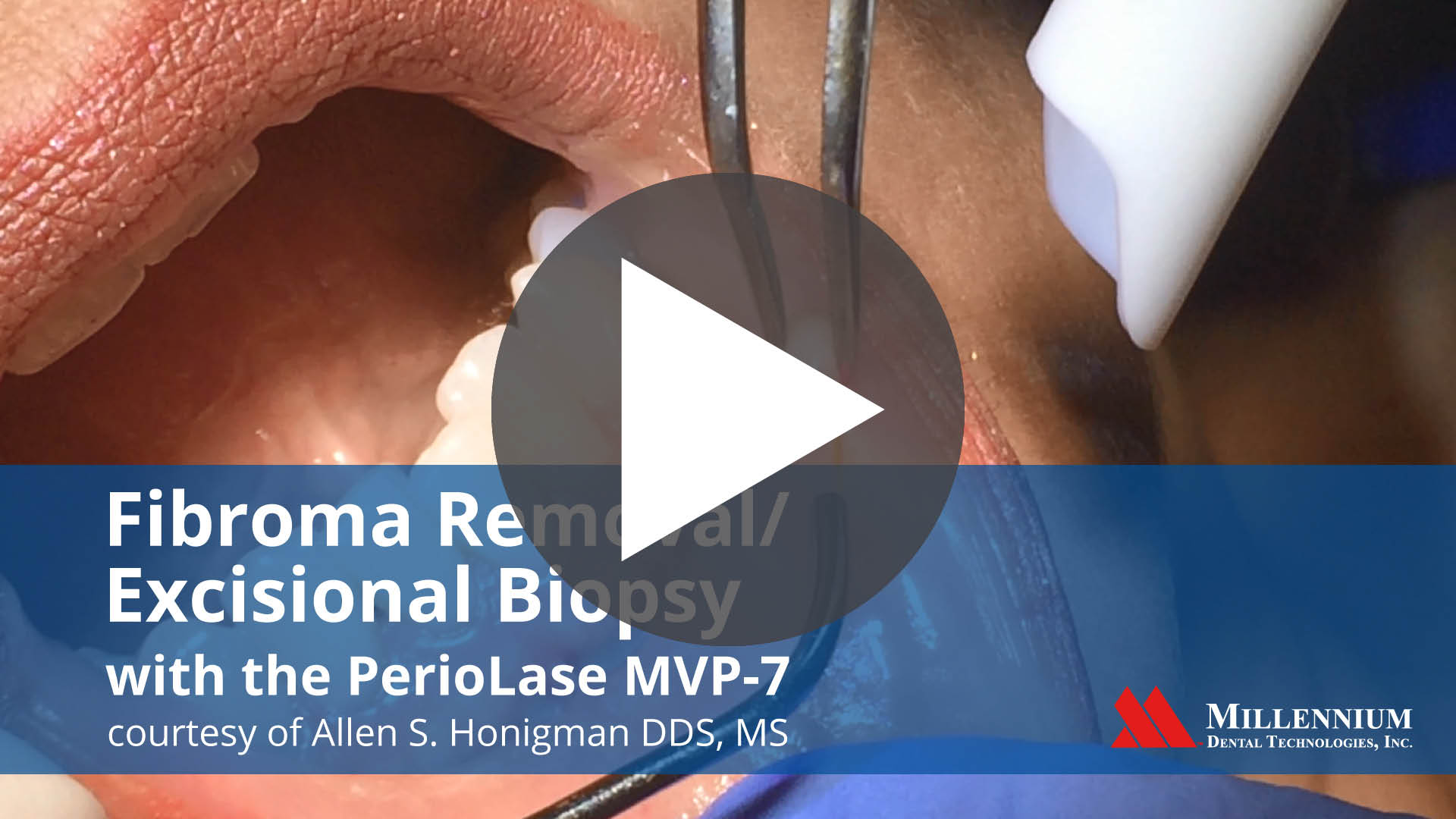 PerioLase Millenium MVP-7 Dental Laser