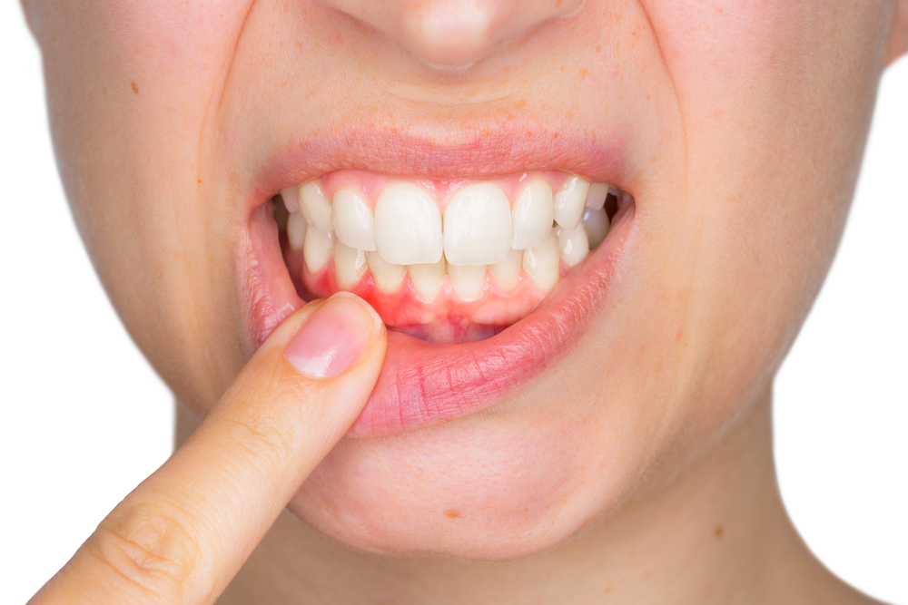 LANAPers Weigh In: Gum Disease Awareness Month