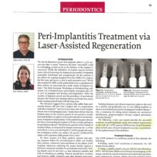 Peri-Implantitis Treatment via Laser-Assisted Regeneration