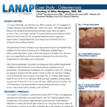 LANAP Case Study: Osteonecrosis, Courtesy of Allen Honigman, DDS