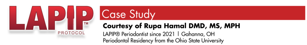 LAPIP case study provided by Rupa Hamal, DMD, MS to successfully treat a failing dental implant