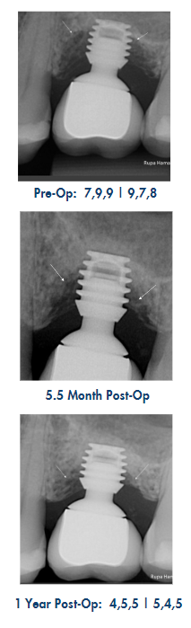 LAPIP case study by Rupa Hamal, DMD, MS. Xrays showing successful treatment of a failing dental implant using the minimally invasive LAPIP protocol