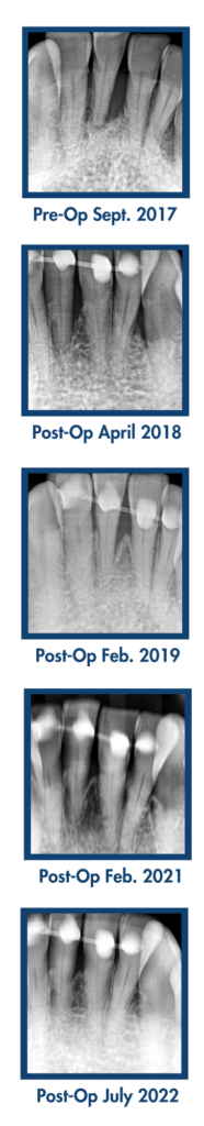LANAP case study by Andrew Erickson, DMD, MS. Xrays showing successful regeneration of alveolar bone around teeth using the minimally invasive LANAP protocol in a phobic patient