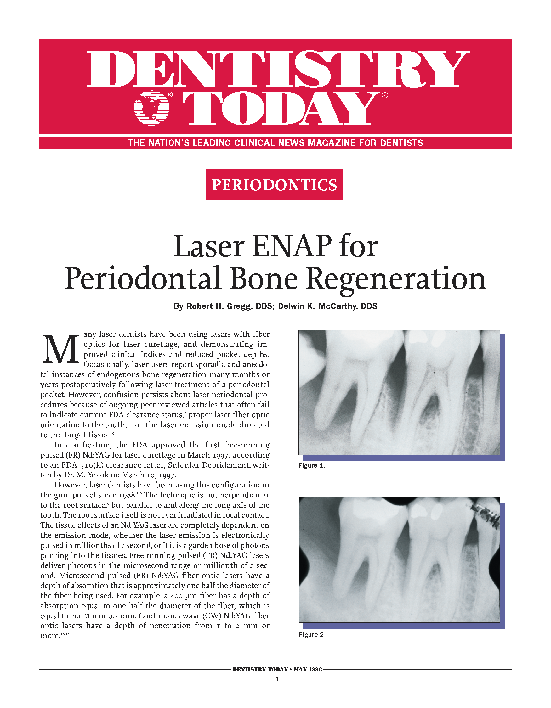 Laser ENAP for Periodontal Bone Regeneration
