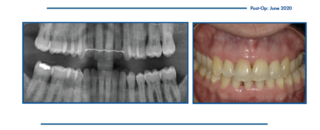 Post op photo after LANAP treatment by Dr Harinder Sandhu DDS PhD showing healthy tissue and bone regeneration